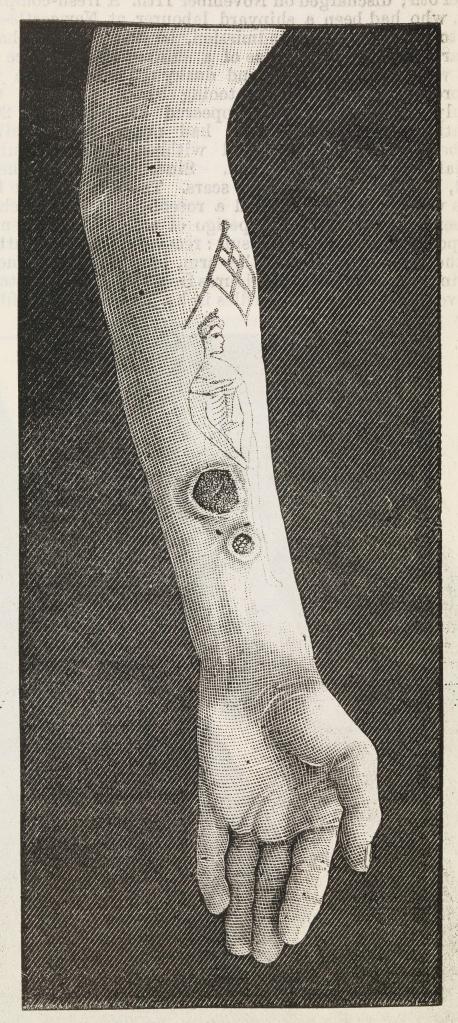 a print of an arm from the elbow down with tattoos and syphilitic ulcers